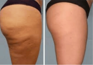 Cellulite Elimination